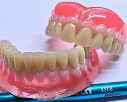 rony dental ahli gigi - gigi palsu - pembuatan (1)