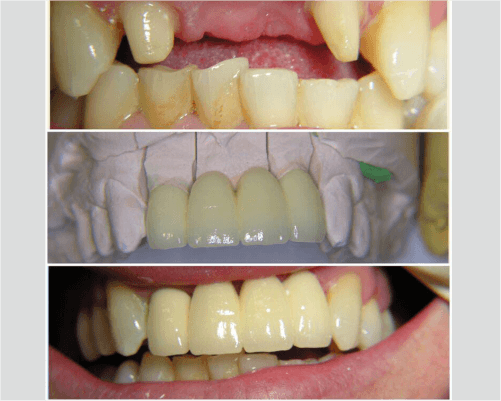 rony dental ahli gigi - pasang jaket gigi - (1)